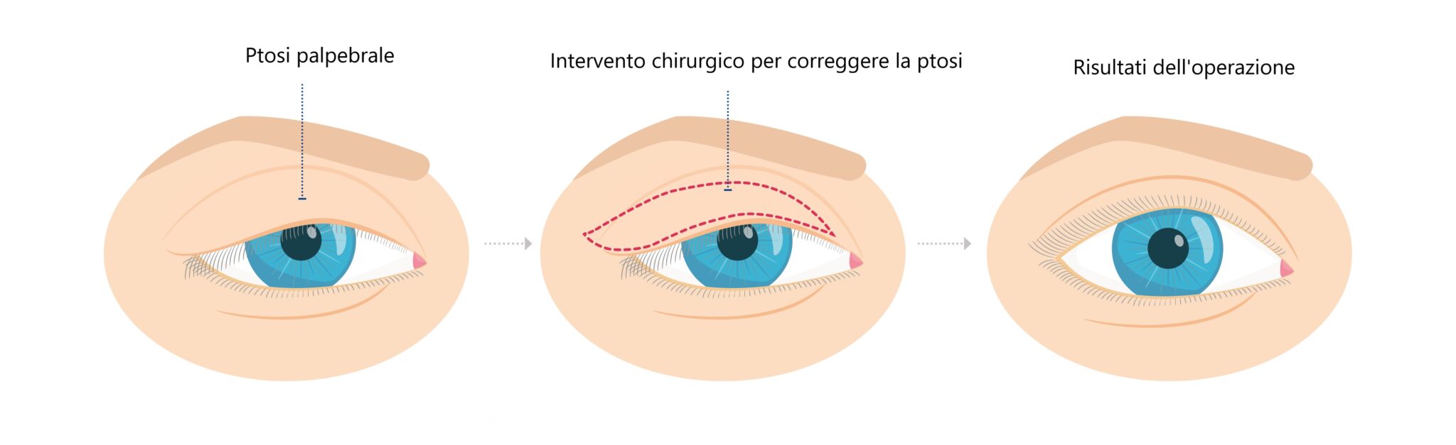 Ptosi Palpebrale O Blefaropstosi Cause E Sintomi Blog Di Clinica