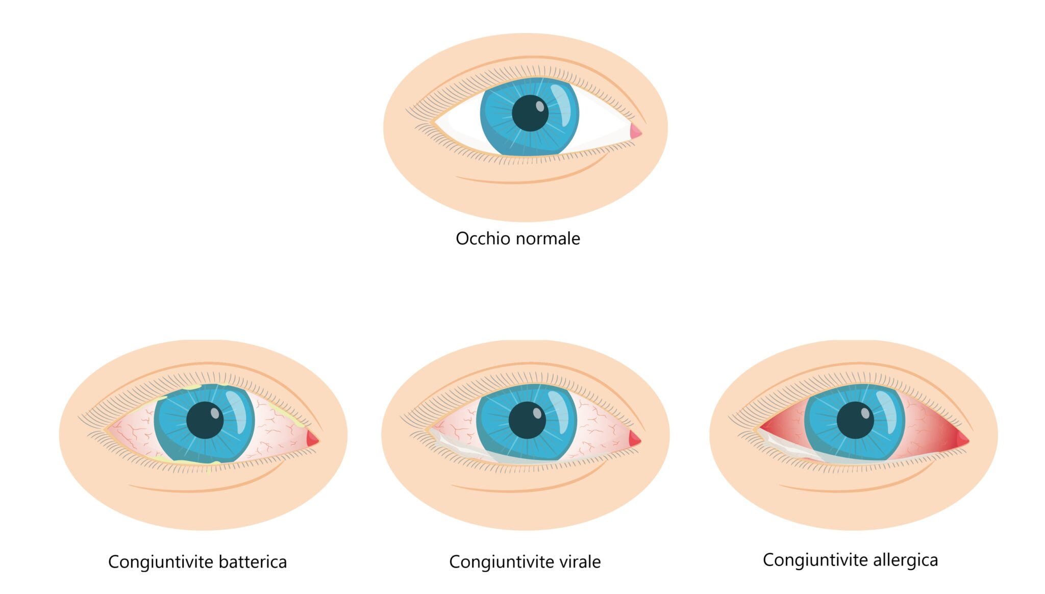 Congiuntivite Virale Sintomi Cause E Terapia Blog Di Clinica Baviera Italia