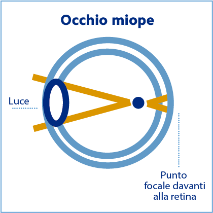 Lenti a contatto on sale miopia e astigmatismo insieme